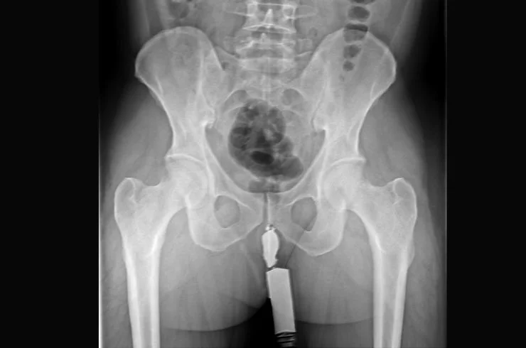 FISTULOGRAM 1