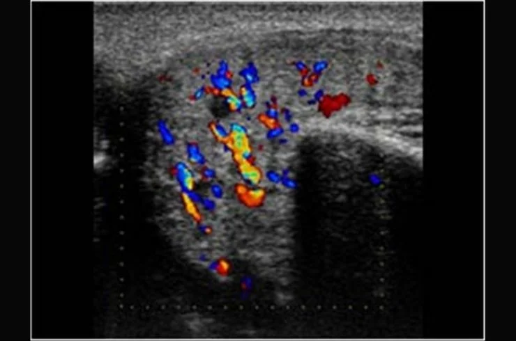 HR. USG NECK_ PAROTID GLAND WITH DOPPLER 1